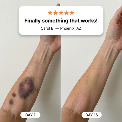 A Gentle Cream That Helps Reduce Bruises on Thin, Fragile Skin