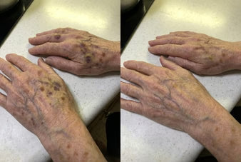 A Gentle Cream That Helps Reduce Bruises on Thin, Fragile Skin