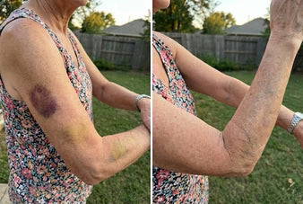 A Gentle Cream That Helps Reduce Bruises on Thin, Fragile Skin