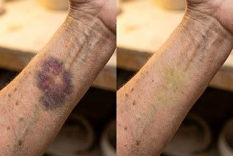 A Gentle Cream That Helps Reduce Bruises on Thin, Fragile Skin
